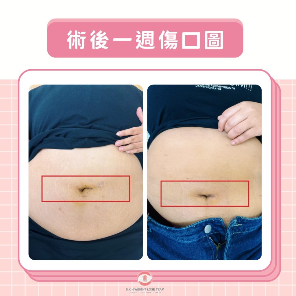 術後傷口