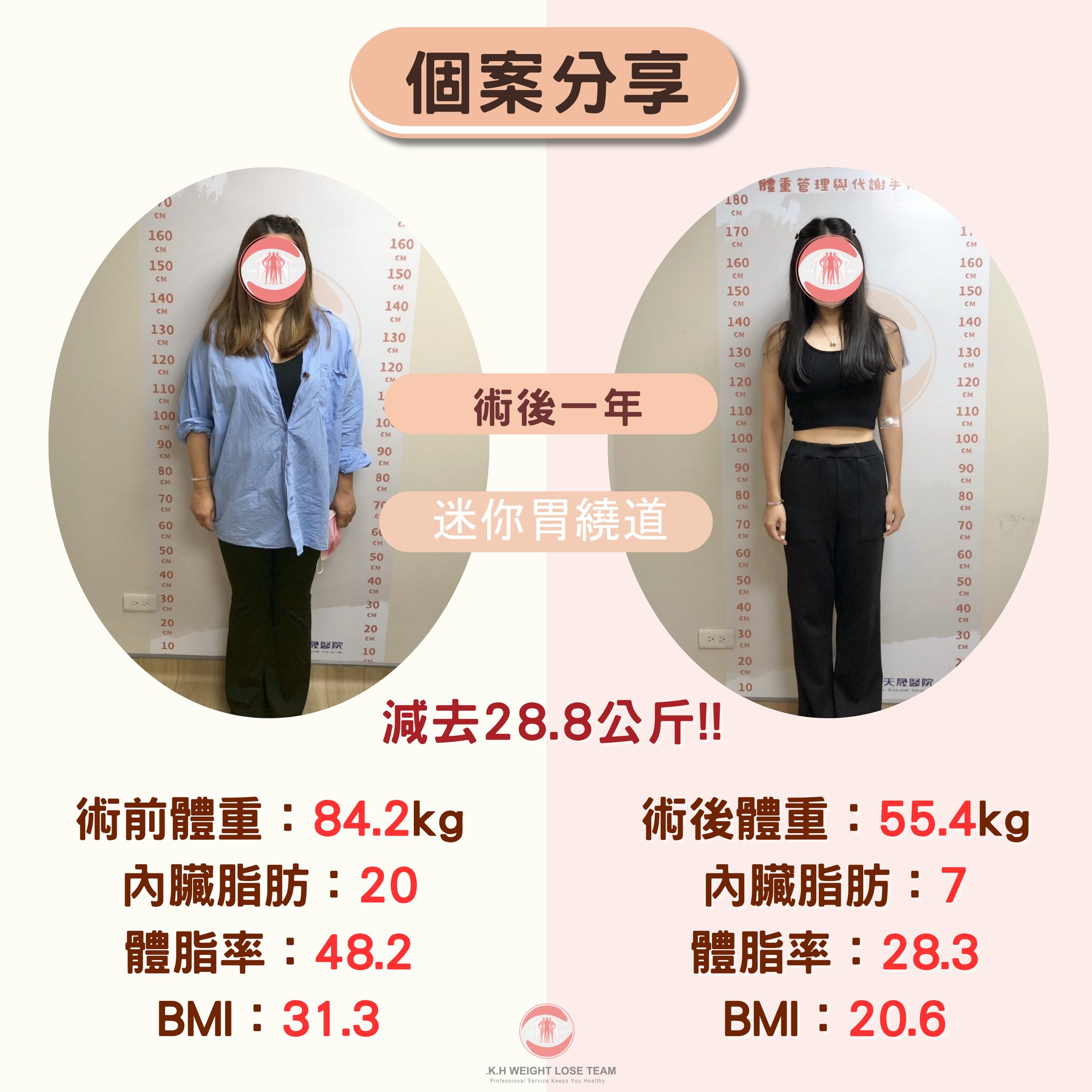 外科減重分享-SASI雙通道縮胃繞道